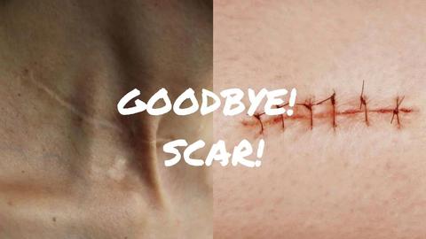 how to get rid of acne scars and stretch marks