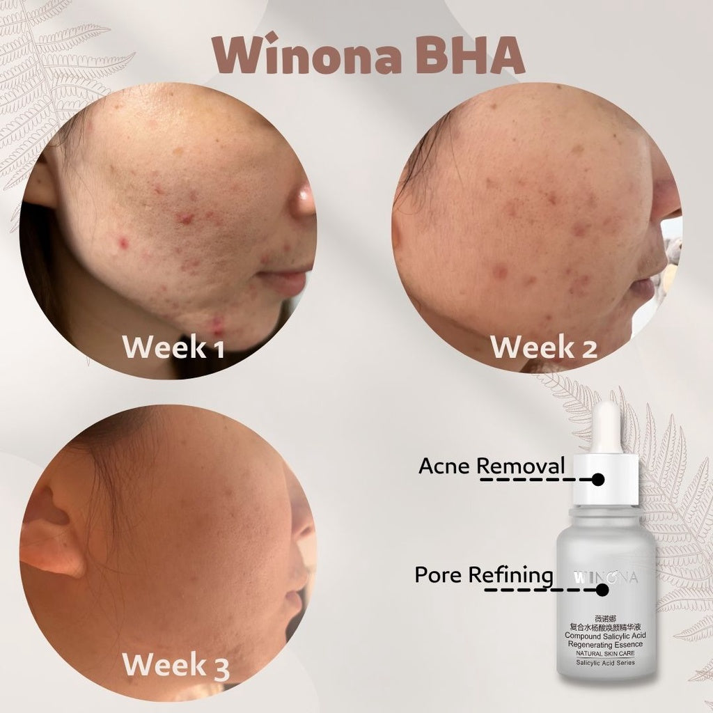 WINONA BHA Series Compound Salicylic Acid Regenerating Anti-Acne Serum T3478
